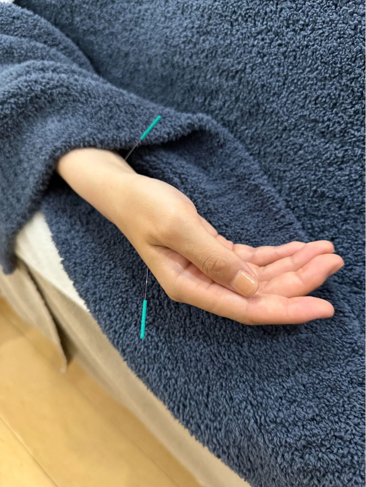 低気圧頭痛に悩む3名の対処法。鍼・耳ツボの画像_5