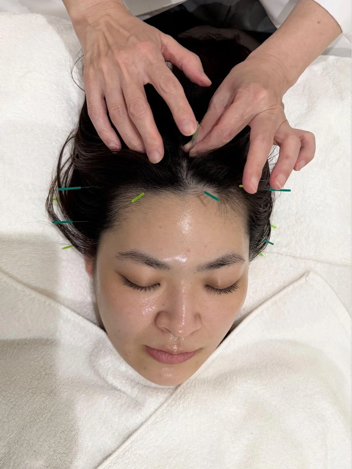低気圧頭痛に悩む3名の対処法。鍼・耳ツボの画像_4