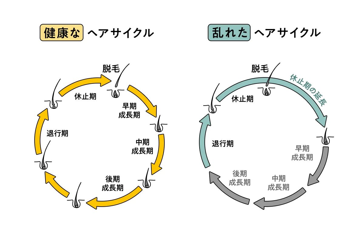 女性における、健康なヘアサイクルと乱れたヘアサイクル